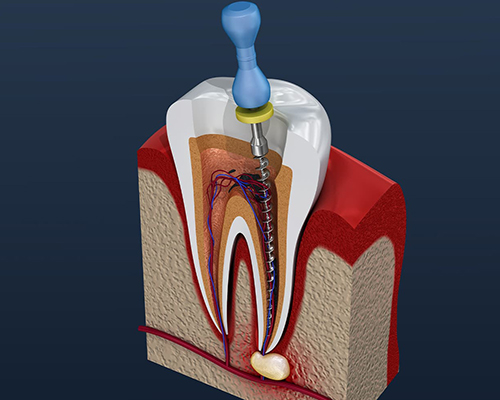 Root Canal Treatment