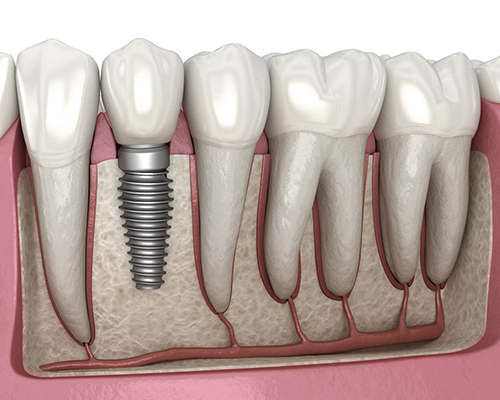 Dental Implants