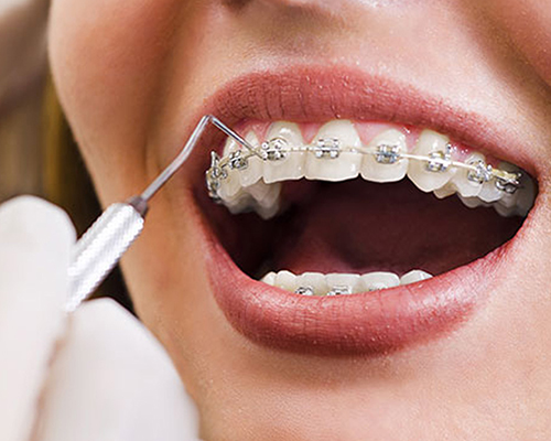 Orthodontic Treatment